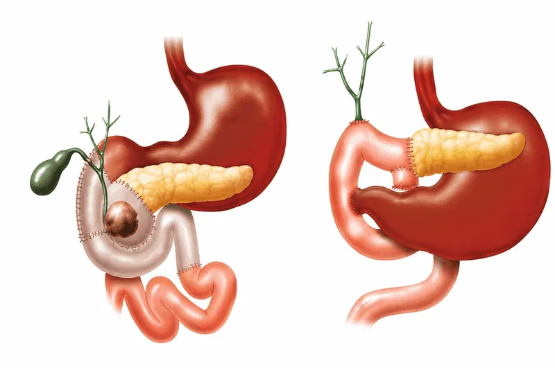 Pancreatoduodenectomía (cirugía de Whipple)